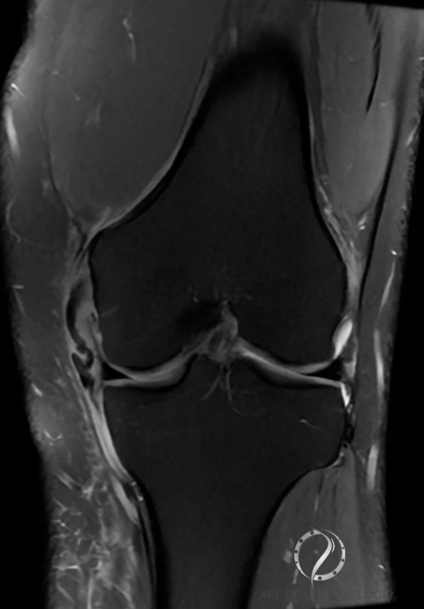 Ligamento Colateral Medial - LCM 4 Lesão do colateral medial ( stener Like )