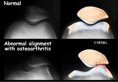 Condropatia - Condromalacia Patelar - Dr Rafael De Luca de Lucena - Porto Alegre - Gravatai - Rio Grande do Sul - Tratamento - Convenio - Especialista - Ortopedista - Joelho - Cartilagem - Dor Anterior - Artrose Patelofemoral