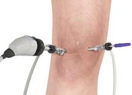 Artroscopia de Joelho Porto Alegre, Gravatai e Cachoeirinha