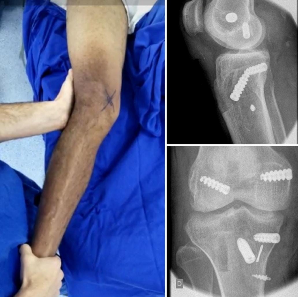 Ligamento Colateral Medial - LCM - Dr Rafael De Luca de Lucena - Porto Alegre - Gravatai - Rio Grande do Sul - Cirurgia - Procedimento - Tratamento - Artrose - Convenio - Especialista - Ortopedista - Trauma - Cirurgia 