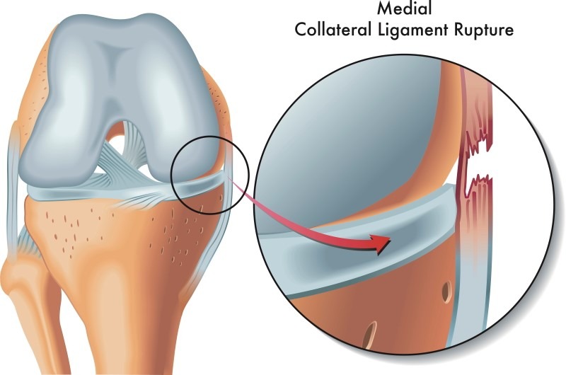 Ligamento Colateral Medial - LCM - Dr Rafael De Luca de Lucena - Porto Alegre - Gravatai - Rio Grande do Sul - Cirurgia - Procedimento - Tratamento - Artrose - Convenio - Especialista - Ortopedista - Trauma - Joelheira