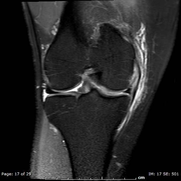 Ligamento Colateral Medial - LCM - Dr Rafael De Luca de Lucena - Porto Alegre - Gravatai - Rio Grande do Sul - Cirurgia - Procedimento - Tratamento - Artrose - Convenio - Especialista - Ortopedista - Trauma - Joelheira - Dor - Ressonancia