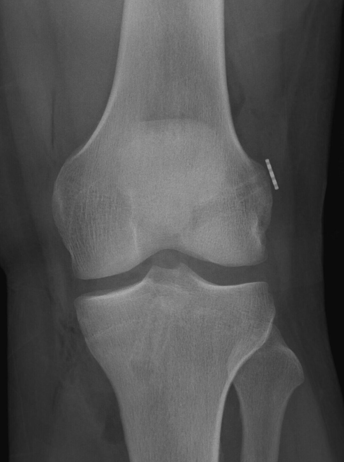 Ruptura Completa do Ligamento Cruzado Anterior - LCA - Dr Rafael De Luca de Lucena - Porto Alegre - Gravatai - Rio Grande do Sul - Cirurgia - Reconstrução - Especialista - Ortopedista - Quem faz - Ipe - Bradesco - Sulamerica - Saudepas - Amil - Doctor Clin - Isseg - 