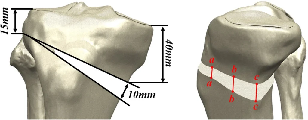 OSTEOTOMIA