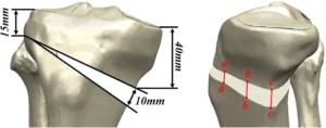 osteotomia tibial alta valgizante cunha de abertura 