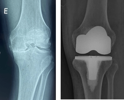 Artroplastia Total de Joelho - Protese - Dr Rafael De Luca de Lucena - Porto Alegre - Gravatai - Rio Grande do Sul - Cirurgia - Procedimento - Tratamento - Artrose - Convenio - Especialista - Ortopedista - Desgaste - Preco - Valor 