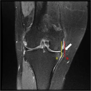 extrusão meniscal 