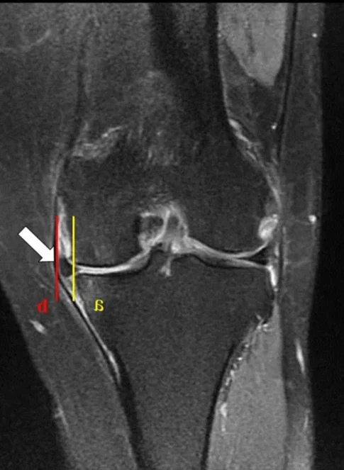 EXTRUSÃO MENISCAL