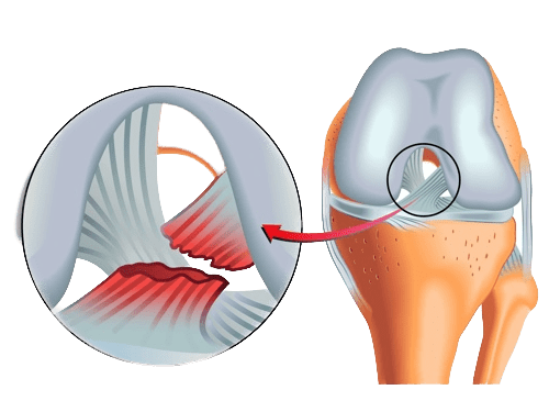 Ruptura Completa do Ligamento Cruzado Anterior - LCA - Dr Rafael De Luca de Lucena - Porto Alegre - Gravatai - Rio Grande do Sul