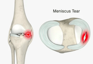 sintomas de ruptura meniscal 