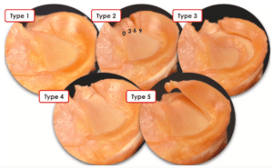 ruptura raiz meniscal 