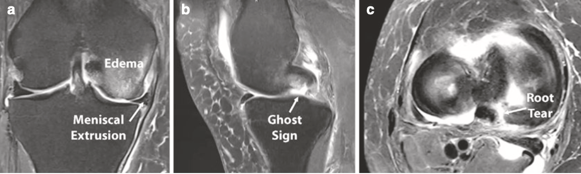 ruptura raiz menisco imagens 