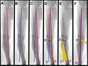 planejamento osteotomia tibial alta valgizante cunha de abertura 