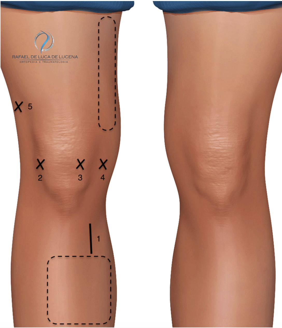 Ruptura Completa do Ligamento Cruzado Anterior - LCA - Dr Rafael De Luca de Lucena - Porto Alegre - Gravatai - Rio Grande do Sul - Cirurgia - Reconstrução - Especialista - Ortopedista