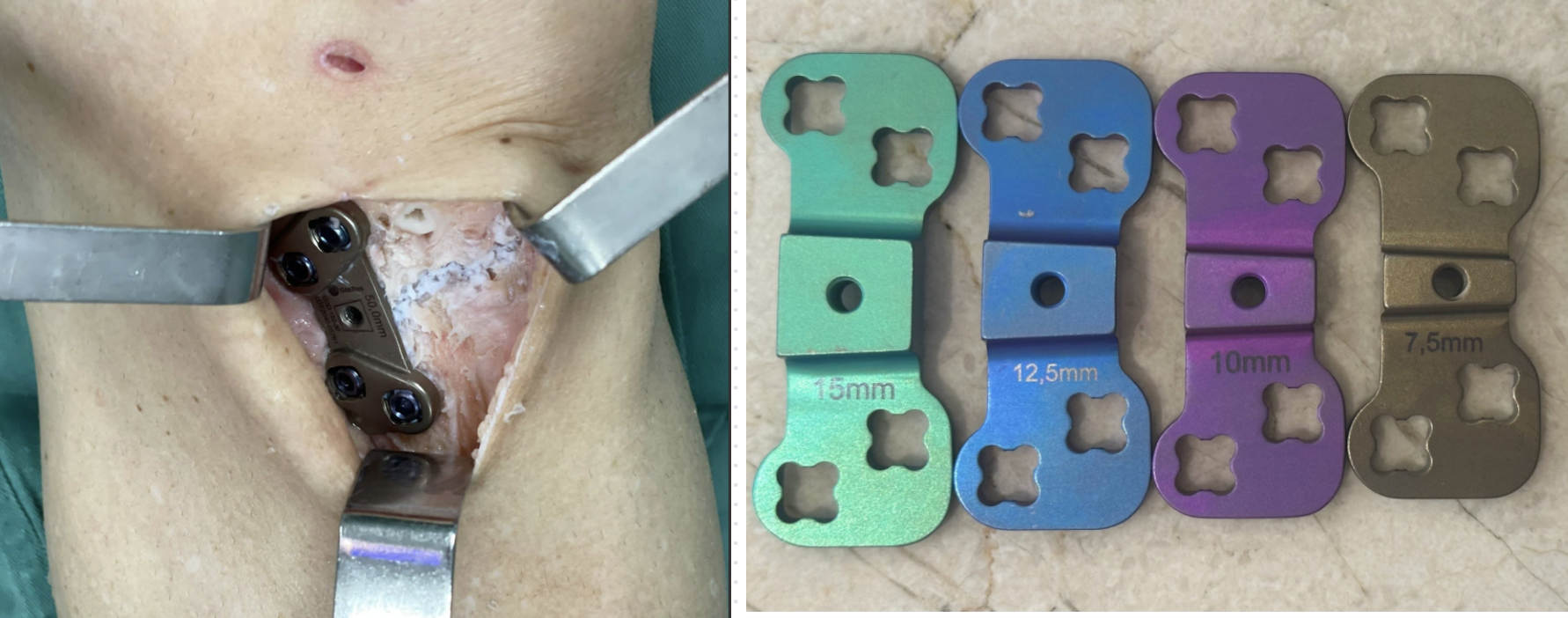 Osteotomia do Joelho 5 Placa com calço de abertura tibial ( 7.5 mm até 15 mm )