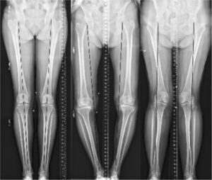 radiografia panoramica membros inferiores demonstrando varo, valgo e normoeixo