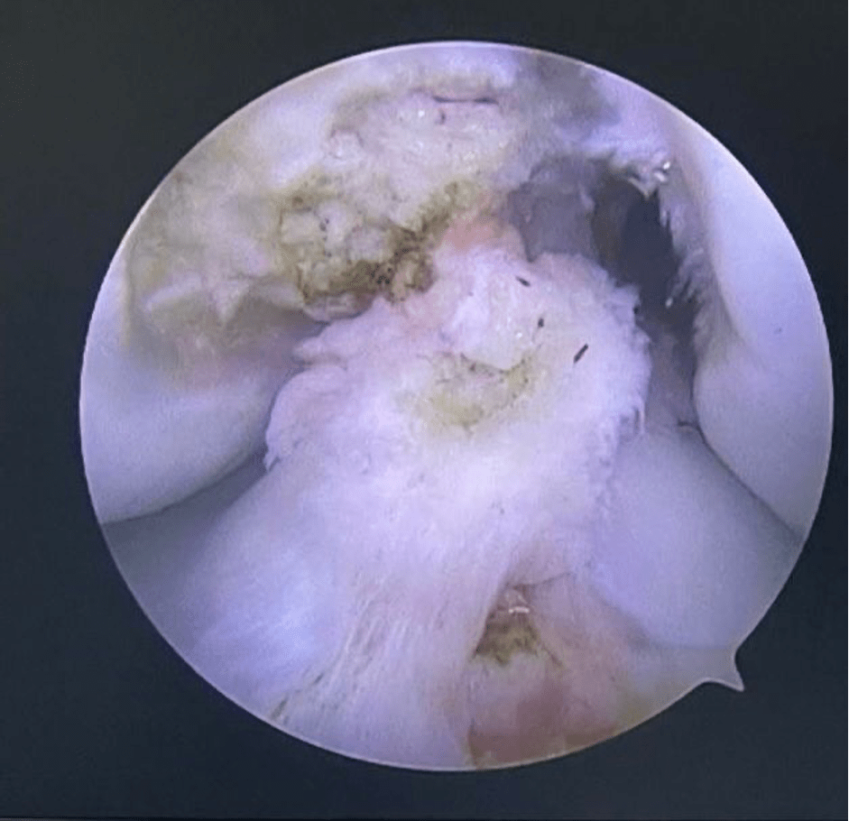 Ruptura Completa do Ligamento Cruzado Anterior - LCA - Dr Rafael De Luca de Lucena - Porto Alegre - Gravatai - Rio Grande do Sul