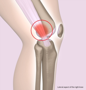 Iliotibial Band Friction Syndrome - Knee & Sports - Orthobullets