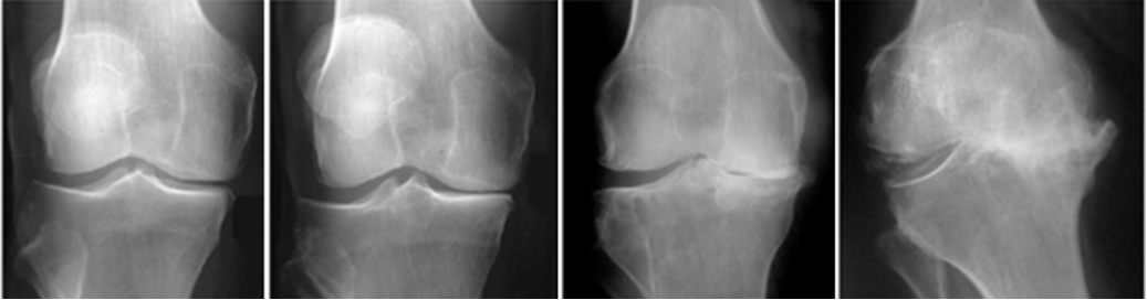 graus de artrose ARTROSE