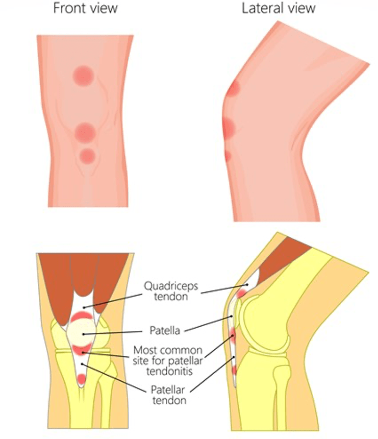 tendinite patelar