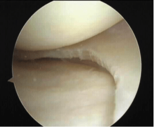 meniscectomia parcial