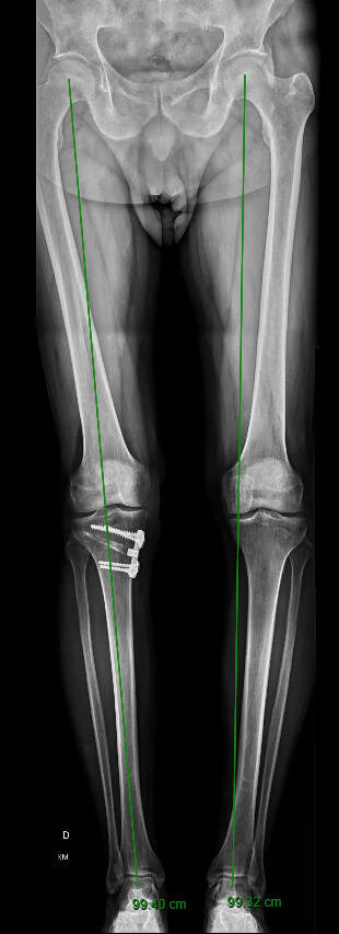 Resultado Osteotomia- Dr Rafael De Luca de Lucena - Porto Alegre e Gravatai - Rio Grande do Sul 