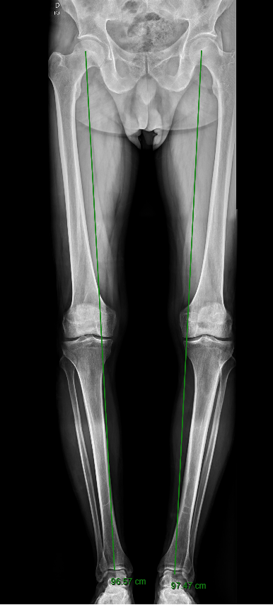 osteotomia alinhamento joelho gravatai porto alegre