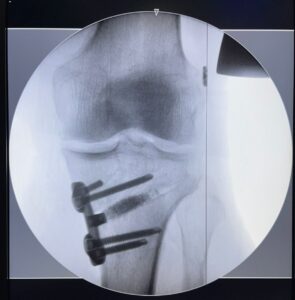 radioscopia transoperatoria puddu e lca 