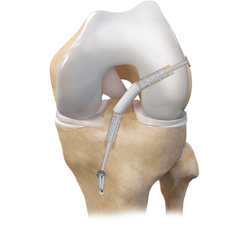 Ruptura Completa do Ligamento Cruzado Anterior - LCA - Dr Rafael De Luca de Lucena - Porto Alegre - Gravatai - Rio Grande do Sul - Cirurgia - Reconstrução - Especialista - Ortopedista - Quem faz - Ipe - Bradesco - Sulamerica - Saudepas - Amil - Doctor Clin - Isseg - 