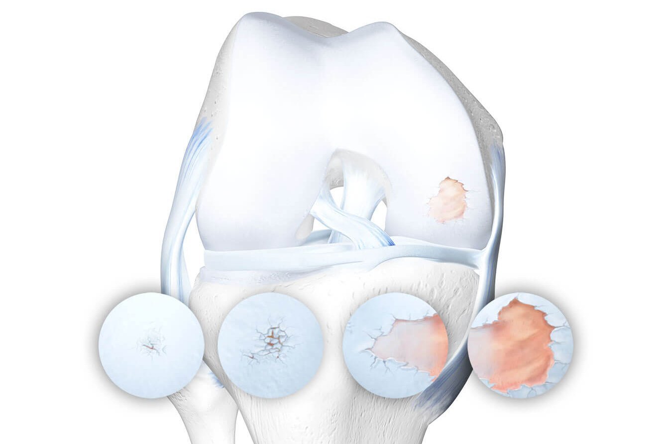 lesão osteocondral