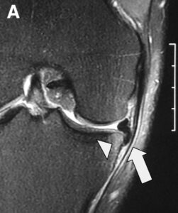 extrusão meniscal com flap para o recesso e edema ósseo por sobrecarga do osso subcondral 