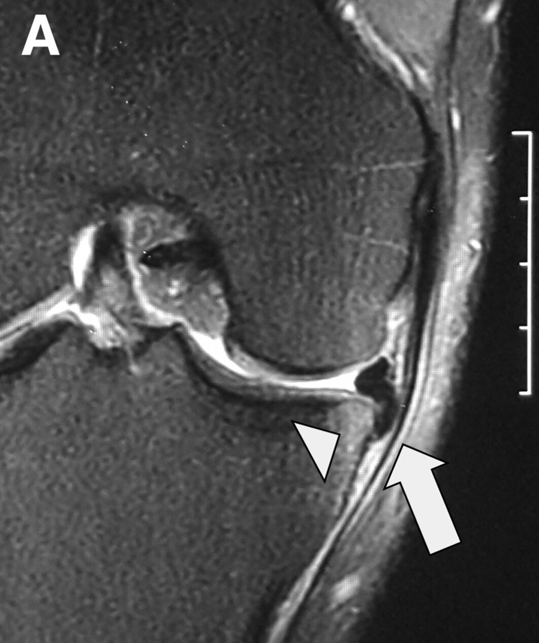 extrusão meniscal com flap para o recesso e edema ósseo por sobrecarga do osso subcondral 