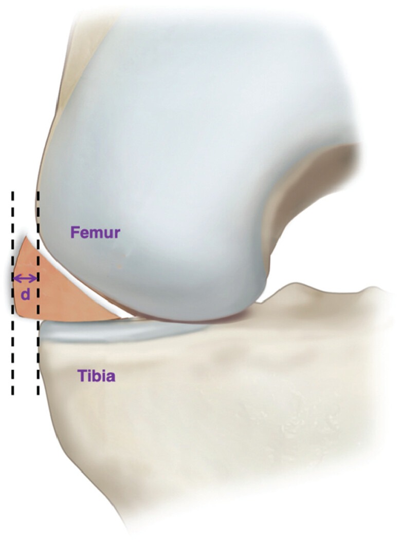 ruptura meniscal gravatai