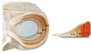 zonas de cicatrização do menisco 