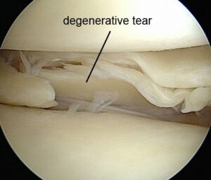 ruptura meniscal degenerativa 