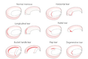 ruptura meniscal tipos lesão radial, lesao longitudinal, horizontal