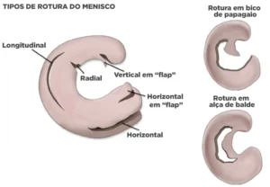 tipos de ruptura meniscal