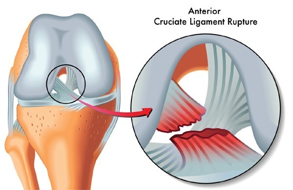 RUPTURA CRUZADO ANTERIOR