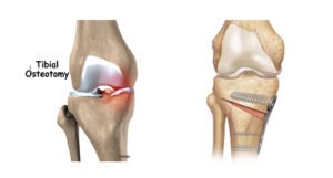 osteotomia tibial alta valgizante cunha de abertura com placa. demonstra sobrecarga mecânica do compartimento medial 