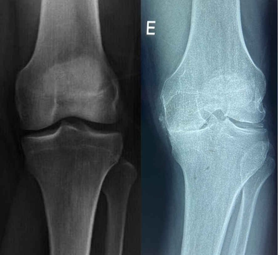 artrose medial