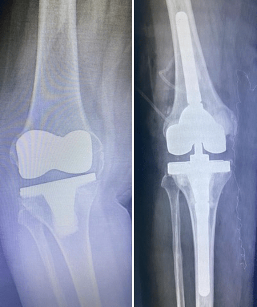 Revisão Artroplastia Total de Joelho - Protese - Dr Rafael De Luca de Lucena - Porto Alegre - Gravatai - Rio Grande do Sul - Cirurgia - Procedimento - Tratamento - Artrose - Convenio - Especialista - Ortopedista - Desgaste - Preco - Valor 