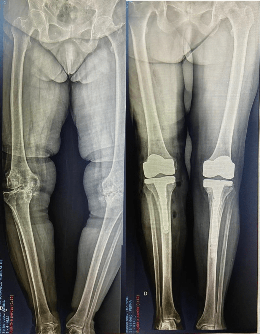 Revisão Artroplastia Total de Joelho - Protese - Dr Rafael De Luca de Lucena - Porto Alegre - Gravatai - Rio Grande do Sul - Cirurgia - Procedimento - Tratamento - Artrose - Convenio - Especialista - Ortopedista - Desgaste - Preco - Valor 