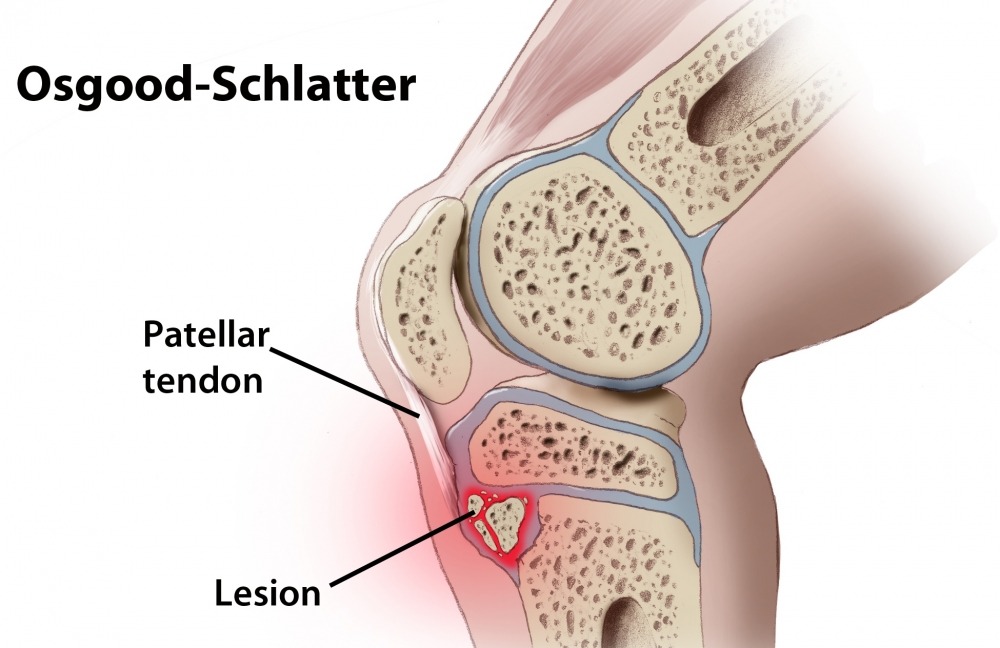 Doença de Osgood Schlatter