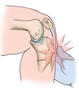 dor no joelho na criança - Osgood-Schlatter