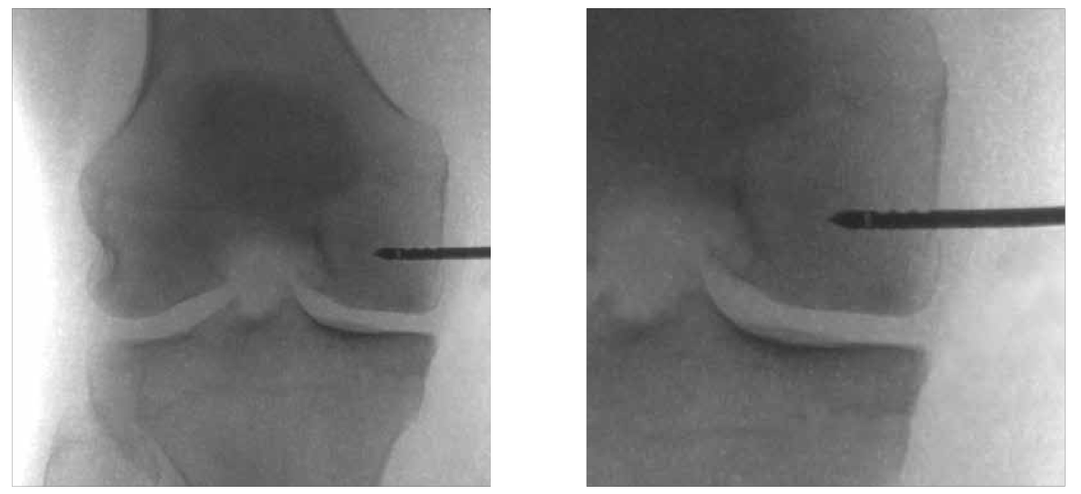 Subcondroplastia no joelho