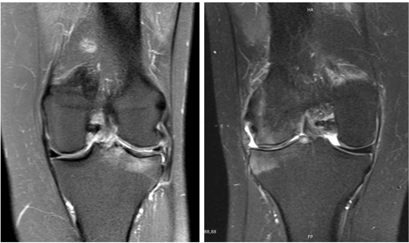 edema ósseo no joelho
