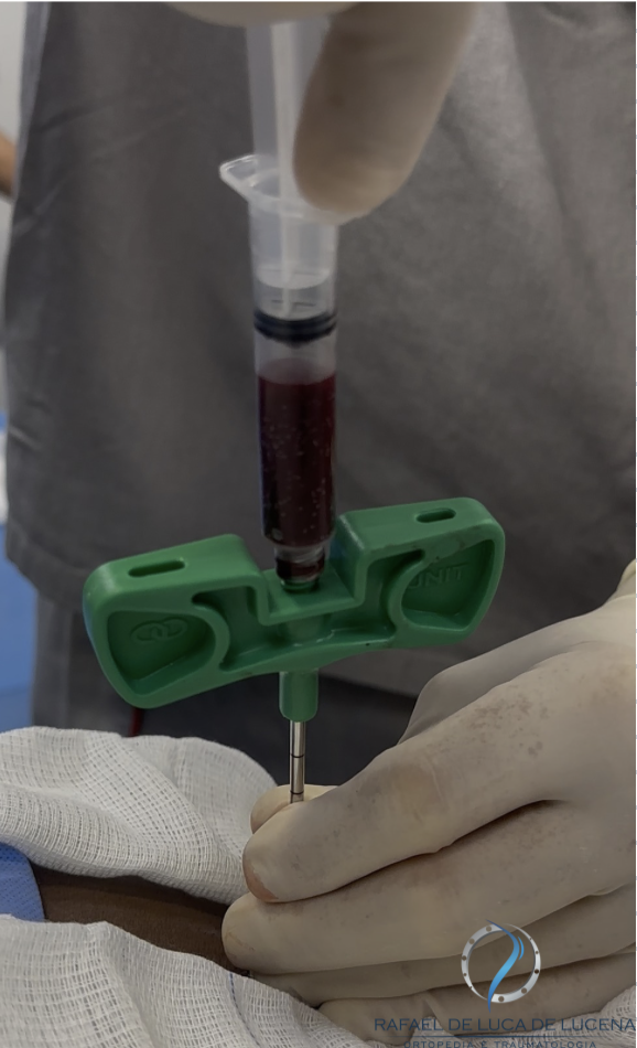 aspirado de medula óssea ( bma ) - bone marrow aspirate