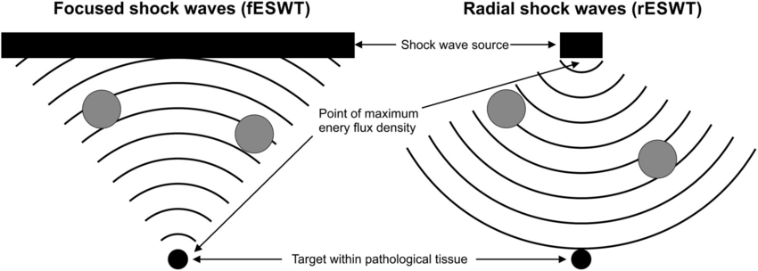 Terapia por Ondas de Choque 1 ondas de choque focal e radial