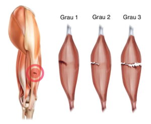 Lesões Musculares - Dr Rafael De Luca de Lucena
