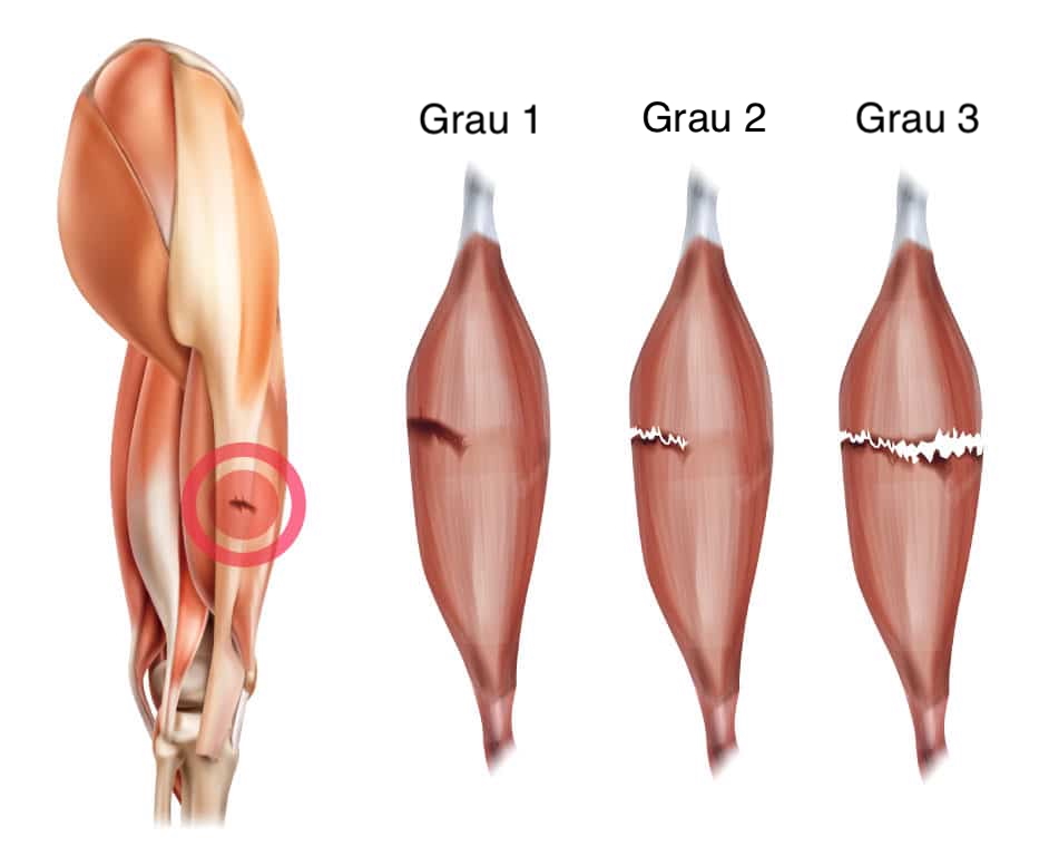 Lesões Musculares - Dr Rafael De Luca de Lucena
